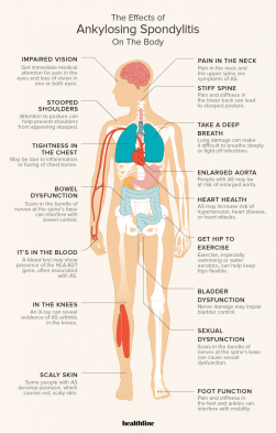 Ankylosing Spondylitis