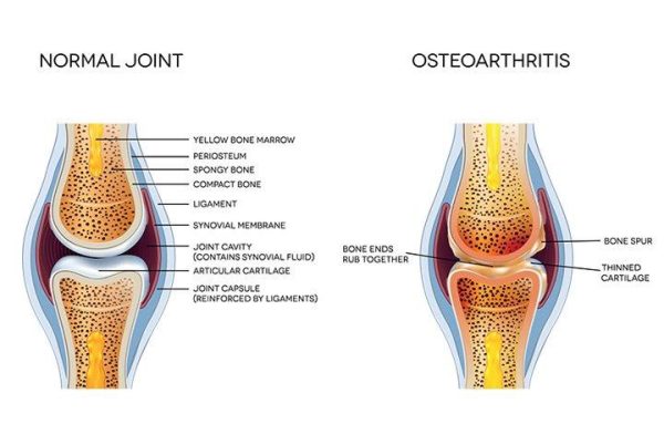 Arthritis In General