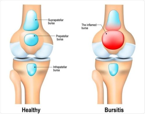 Bursitis