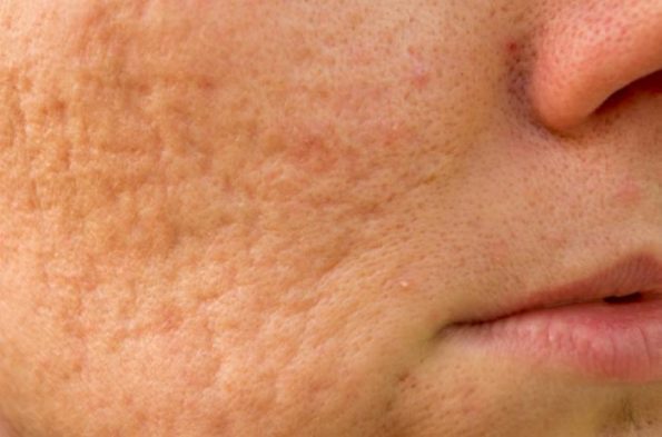 Cysts Acne