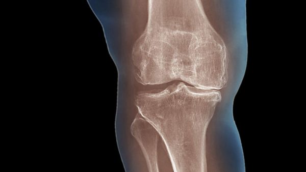 Degenerative Or Mechanical Arthritis