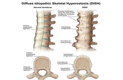Diffuse Idiopathic Skeletal Hyperostosis (DISH)