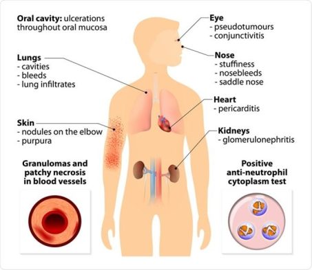 Granulomatosis With Polyangiitis