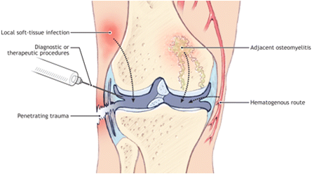 Infectious Arthritis