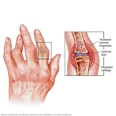 Inflammatory Arthritis