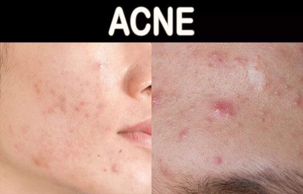 Moderate Acne