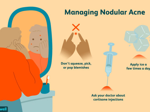 Nodules Acne