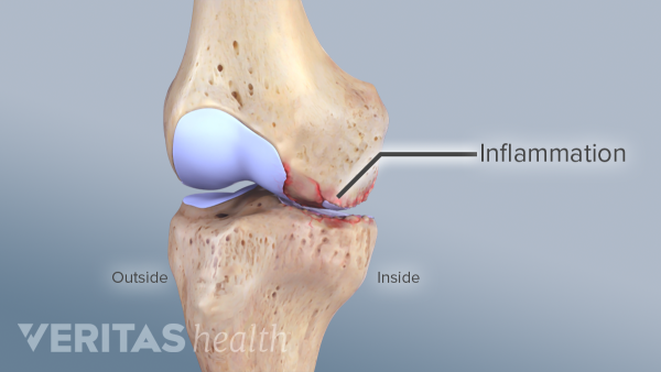 Osteoarthritis