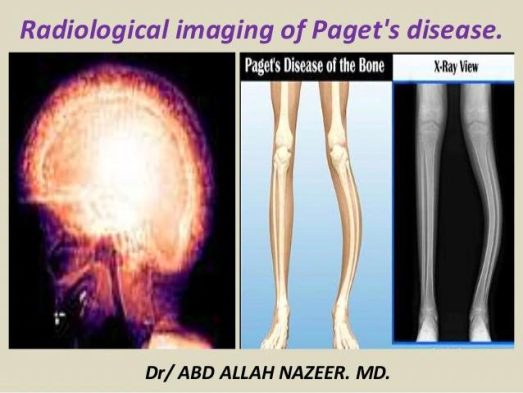 Paget's Disease