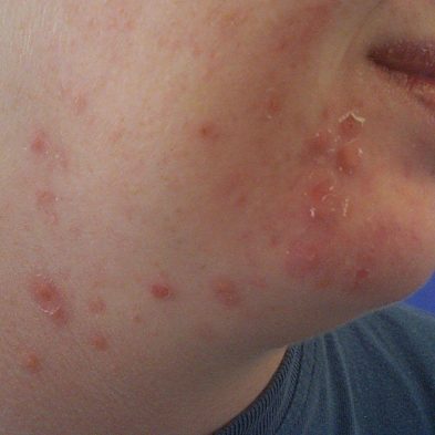 Papules Acne