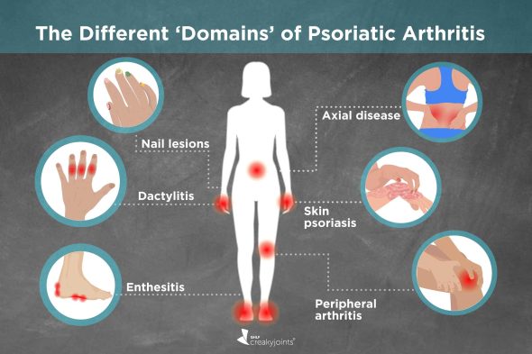 Psoriatic Arthritis