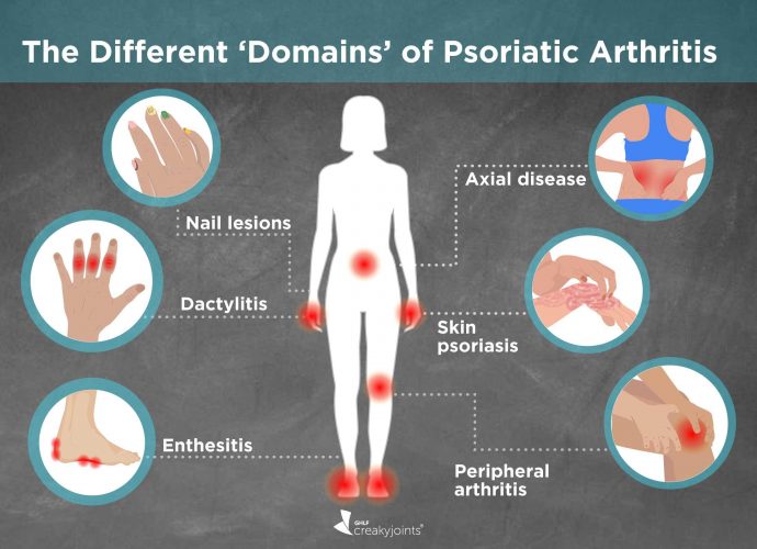 Psoriatic Arthritis