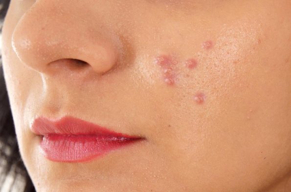 Pustules Acne