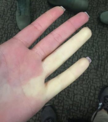 Raynauds Phenomenon