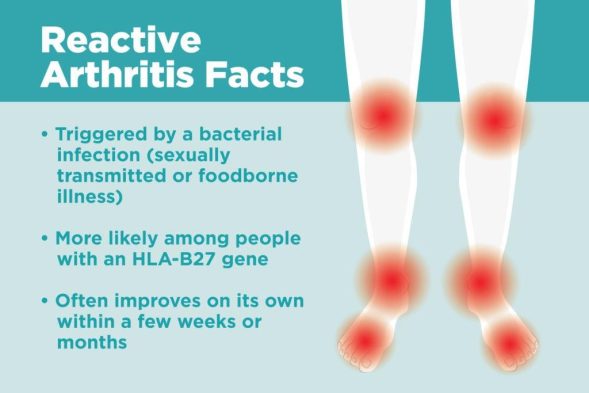 Reactive Arthritis