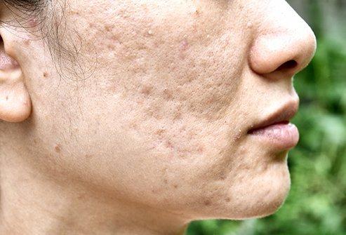 Severe Acne