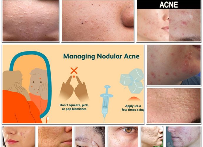 Types of Acne