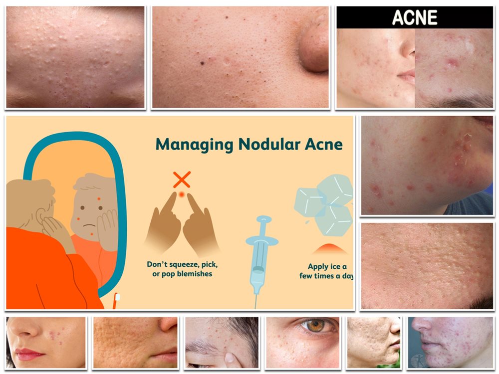 Types of Acne