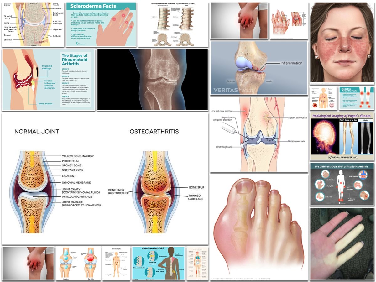 Types of Arthritis