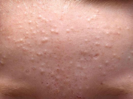 Whiteheads Acne